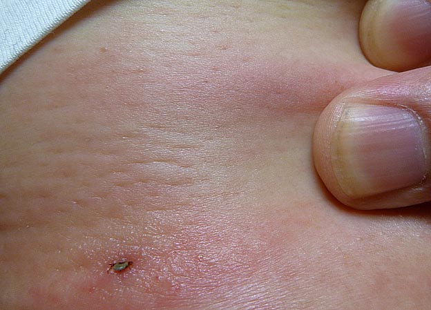 背中側にかみついたマダニ